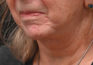Deep Plane Facelift & Neck Lift Before & After Gallery - Patient 408229 - Image 12