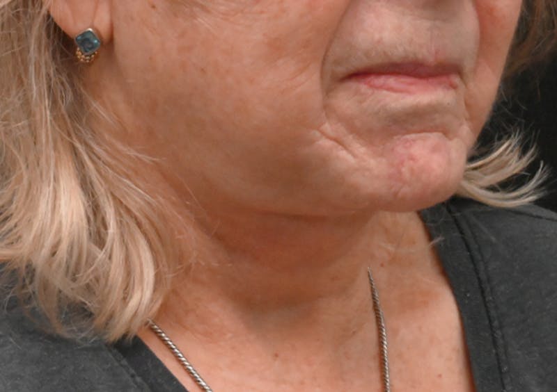 Facelift Before & After Gallery - Patient 408229 - Image 6