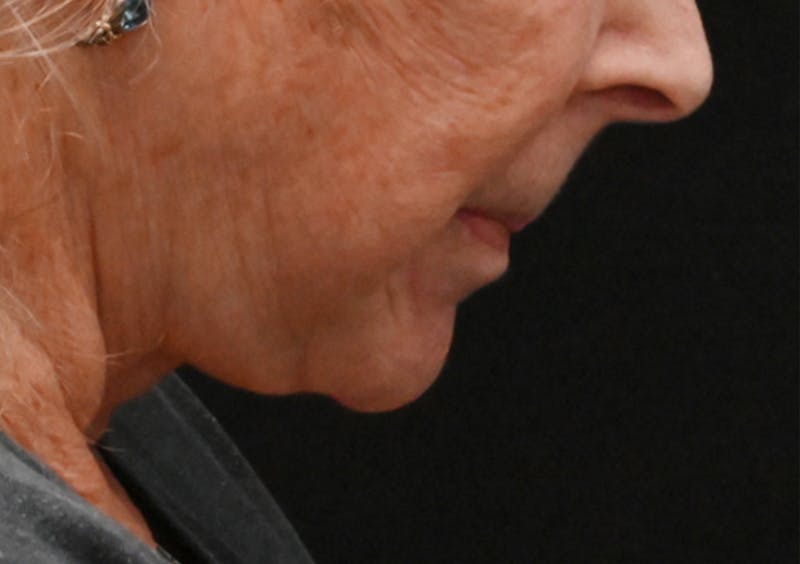 Facelift Before & After Gallery - Patient 408229 - Image 4