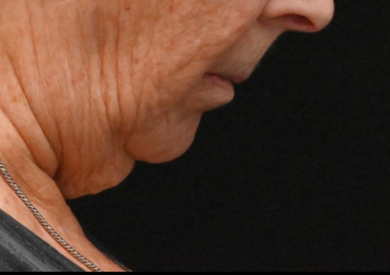 Facelift Before & After Gallery - Patient 408229 - Image 3