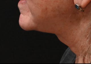 Deep Plane Facelift & Neck Lift Before & After Gallery - Patient 408229 - Image 8
