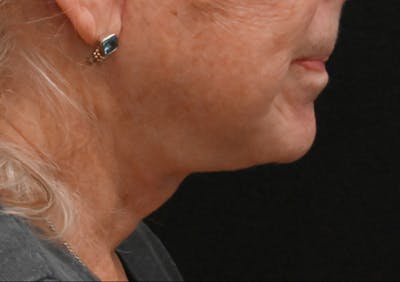 Facelift Before & After Gallery - Patient 408229 - Image 2
