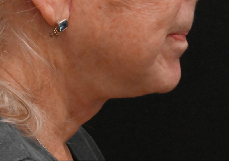 Facelift Before & After Gallery - Patient 408229 - Image 2