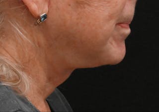 Deep Plane Facelift & Neck Lift Before & After Gallery - Patient 408229 - Image 2