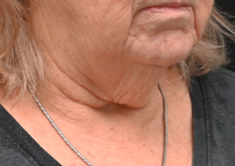 Facelift Before & After Gallery - Patient 408229 - Image 5