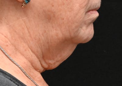Facelift Before & After Gallery - Patient 408229 - Image 1