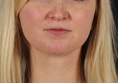 Liposuction Before & After Gallery - Patient 164579 - Image 2