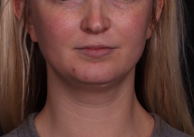 Liposuction Before & After Gallery - Patient 164579 - Image 1