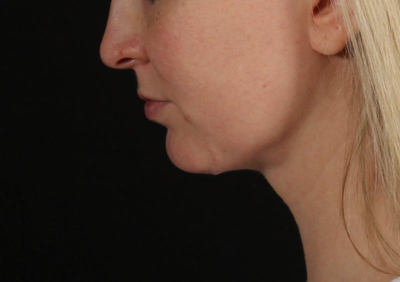 Liposuction Before & After Gallery - Patient 164579 - Image 14
