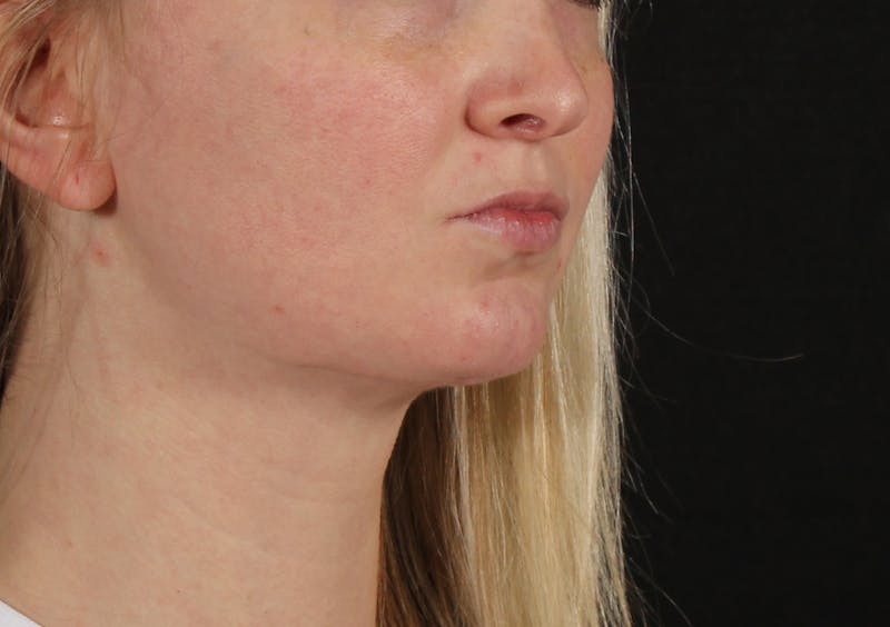 Liposuction Before & After Gallery - Patient 164579 - Image 4