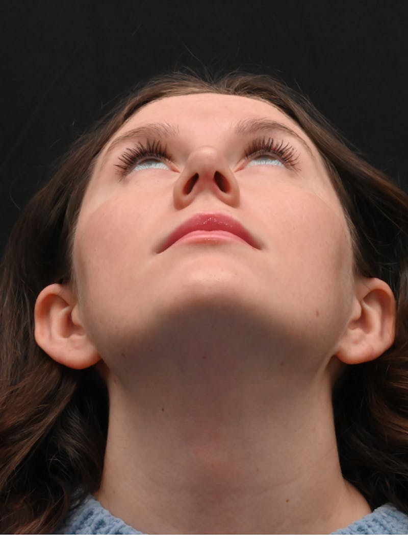 Rhinoplasty Before & After Gallery - Patient 334327 - Image 12