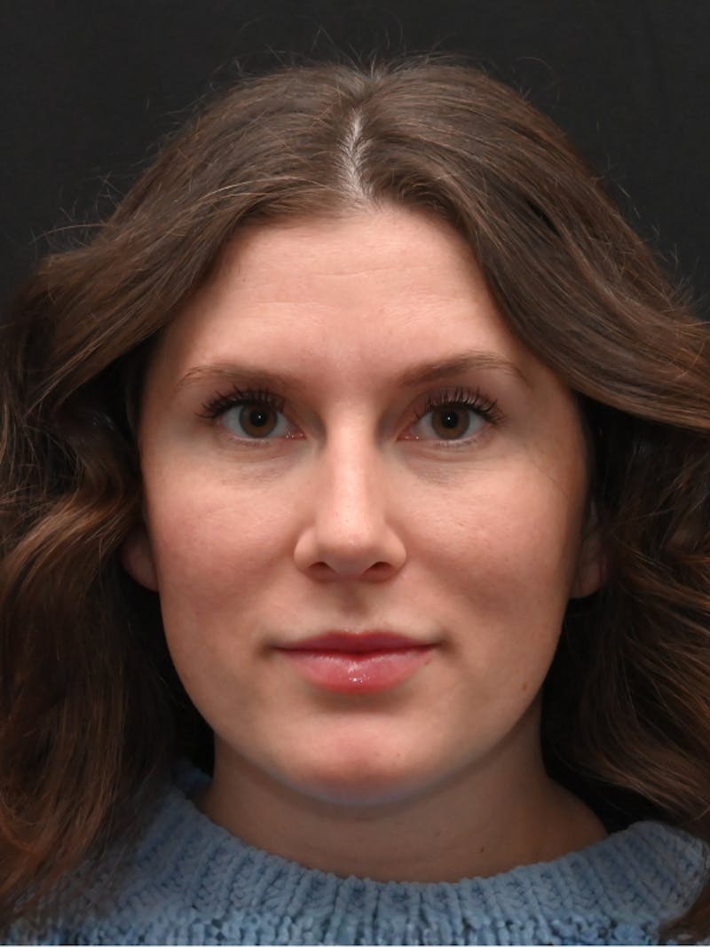 Rhinoplasty Before & After Gallery - Patient 334327 - Image 4