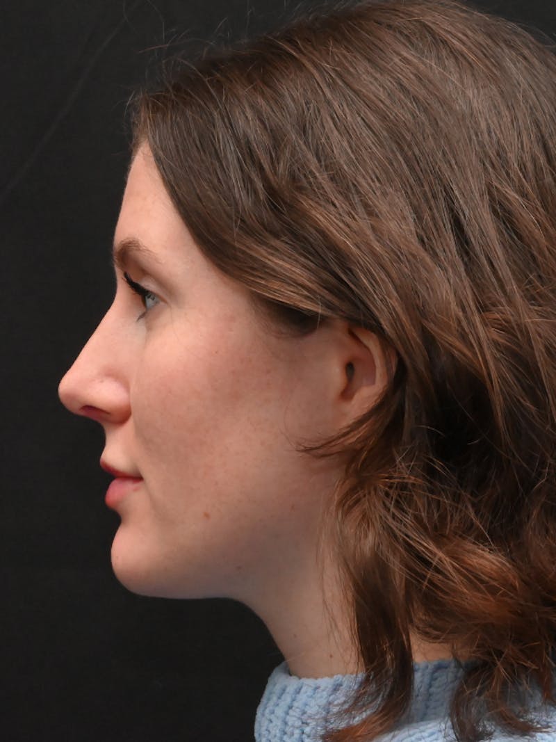 Rhinoplasty Before & After Gallery - Patient 334327 - Image 10