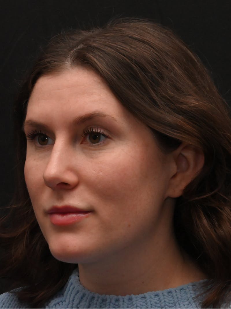 Rhinoplasty Before & After Gallery - Patient 334327 - Image 8