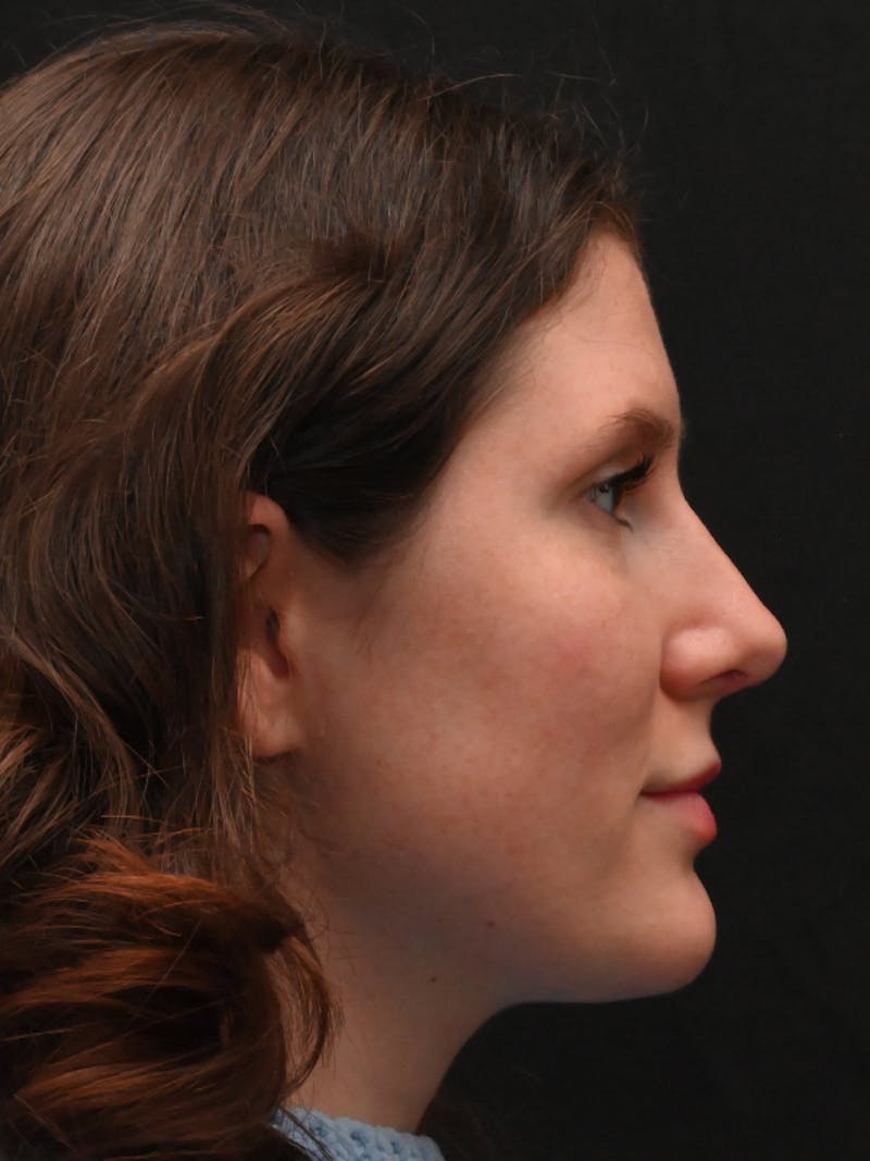 Rhinoplasty Before & After Gallery - Patient 334327 - Image 6