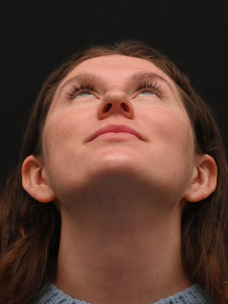 Rhinoplasty Before & After Gallery - Patient 334327 - Image 11