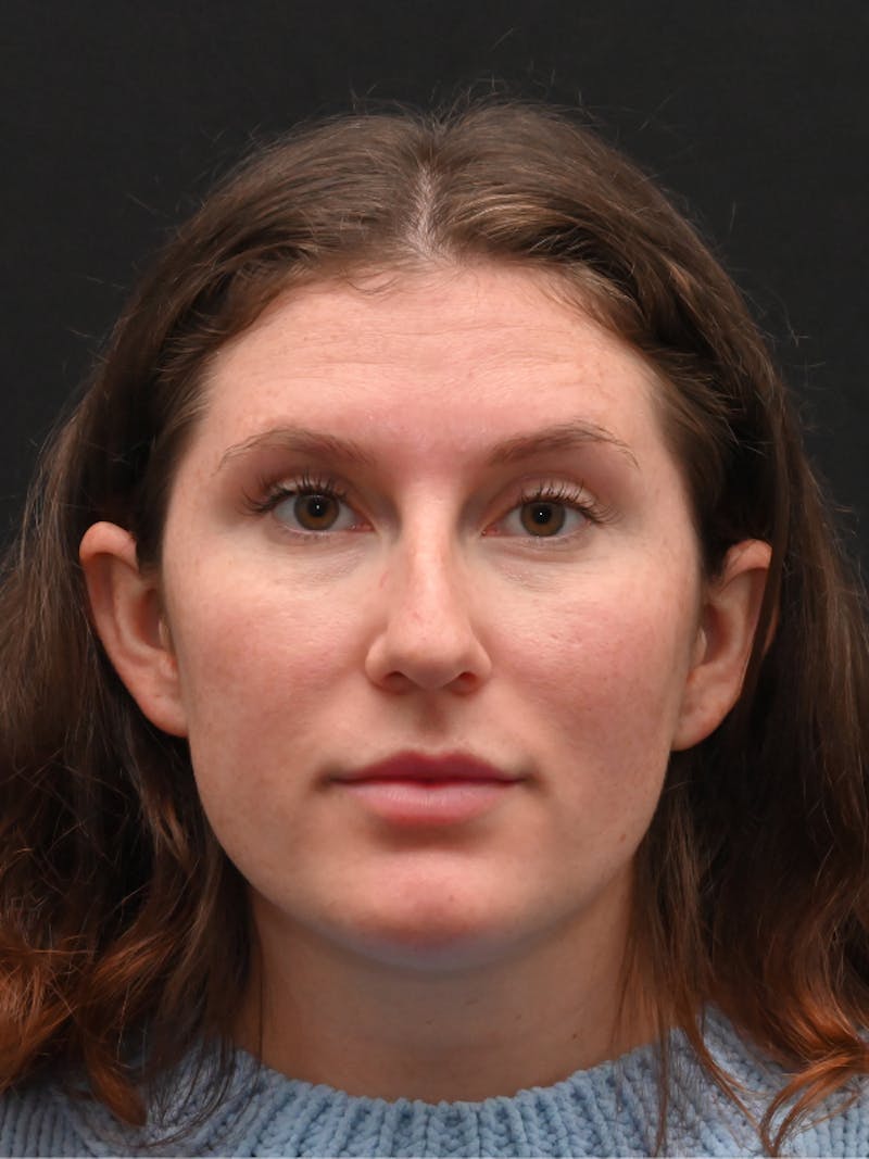 Rhinoplasty Before & After Gallery - Patient 334327 - Image 3