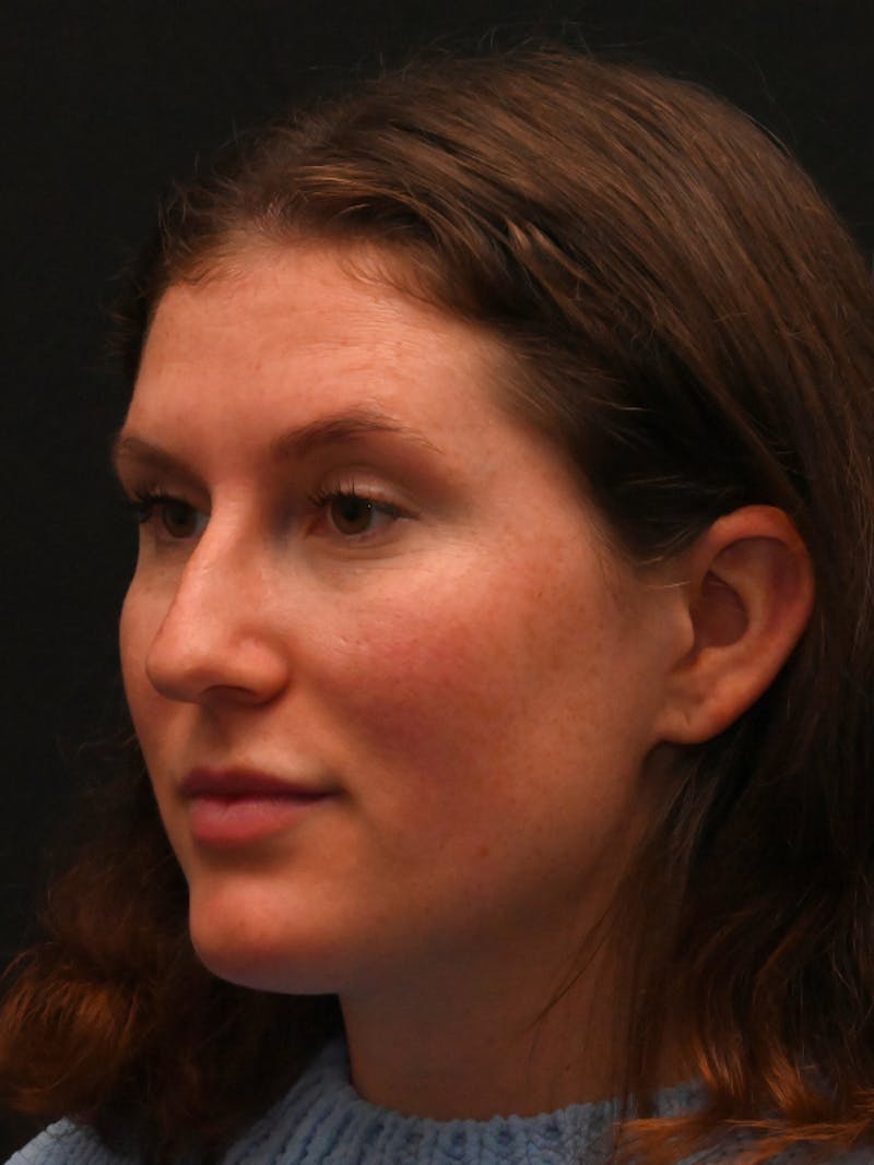 Rhinoplasty Before & After Gallery - Patient 334327 - Image 7