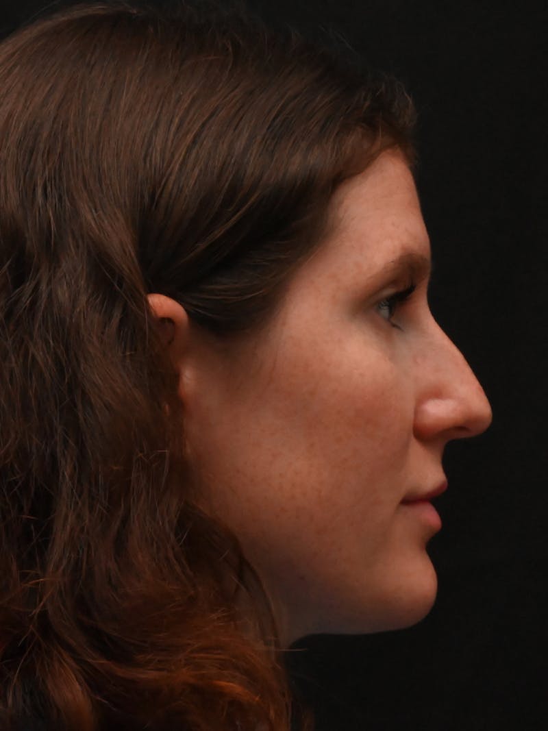 Rhinoplasty Before & After Gallery - Patient 334327 - Image 5