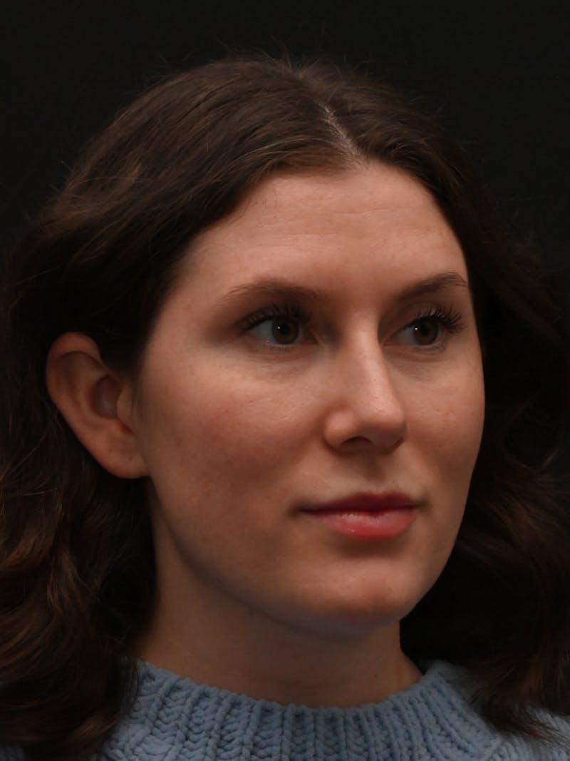 Rhinoplasty Before & After Gallery - Patient 334327 - Image 2