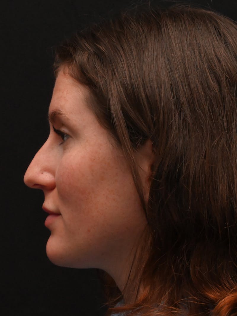Rhinoplasty Before & After Gallery - Patient 334327 - Image 9