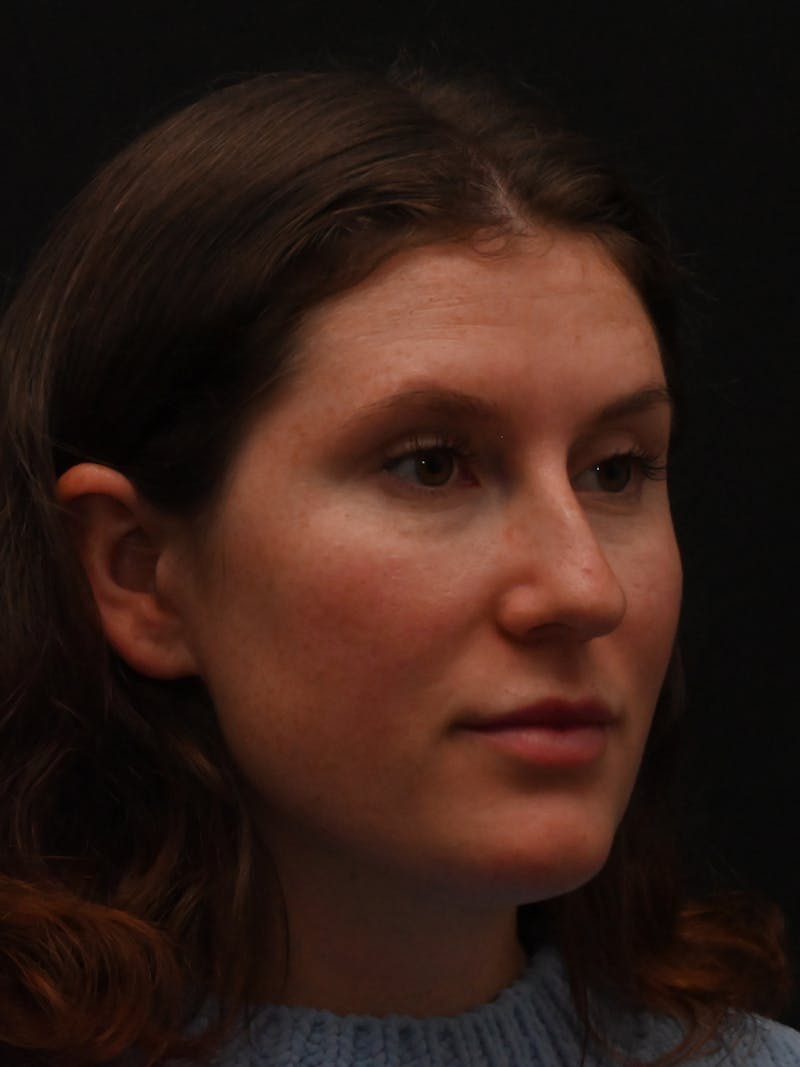 Rhinoplasty Before & After Gallery - Patient 334327 - Image 1