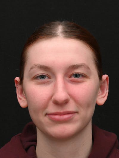 Otoplasty Before & After Gallery - Patient 233584 - Image 2