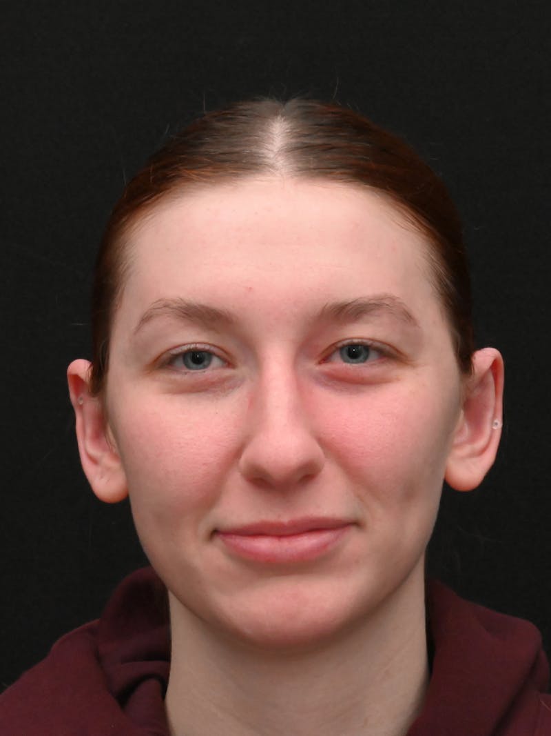 Otoplasty Before & After Gallery - Patient 233584 - Image 2