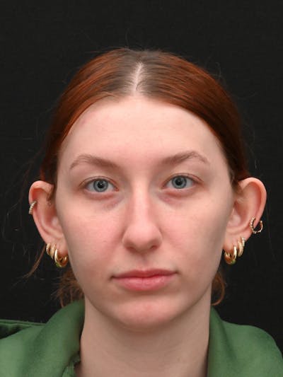 Otoplasty Before & After Gallery - Patient 233584 - Image 1