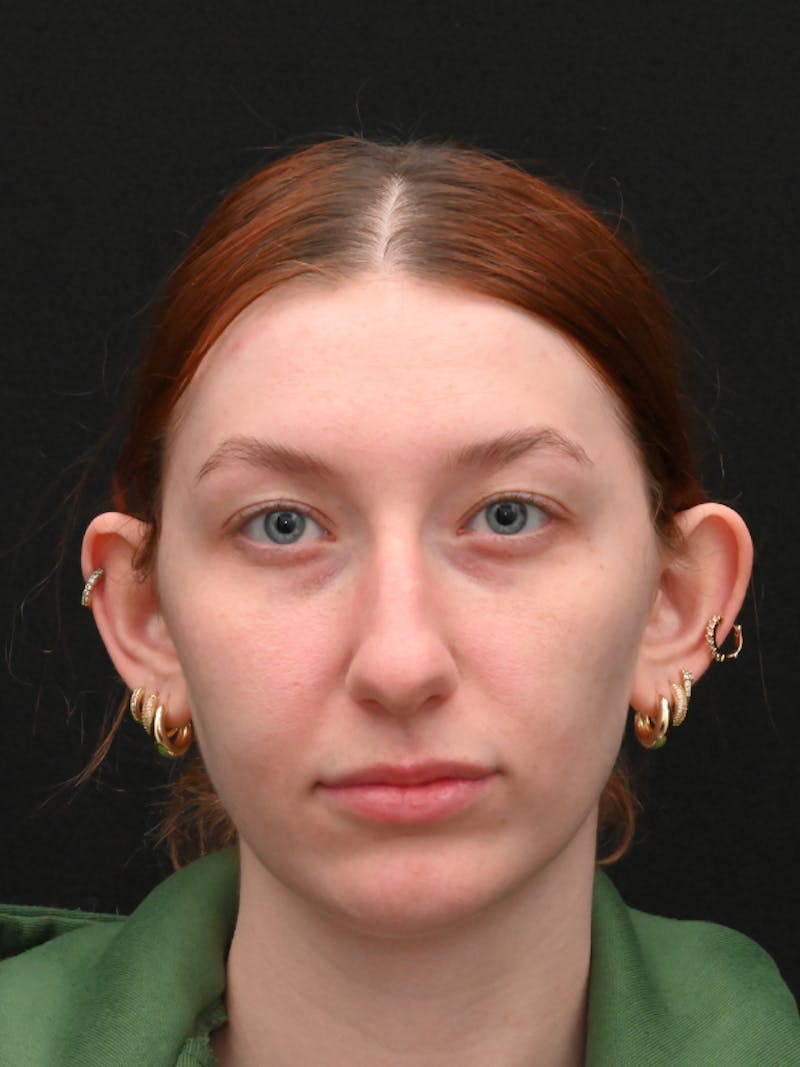 Otoplasty Before & After Gallery - Patient 233584 - Image 1