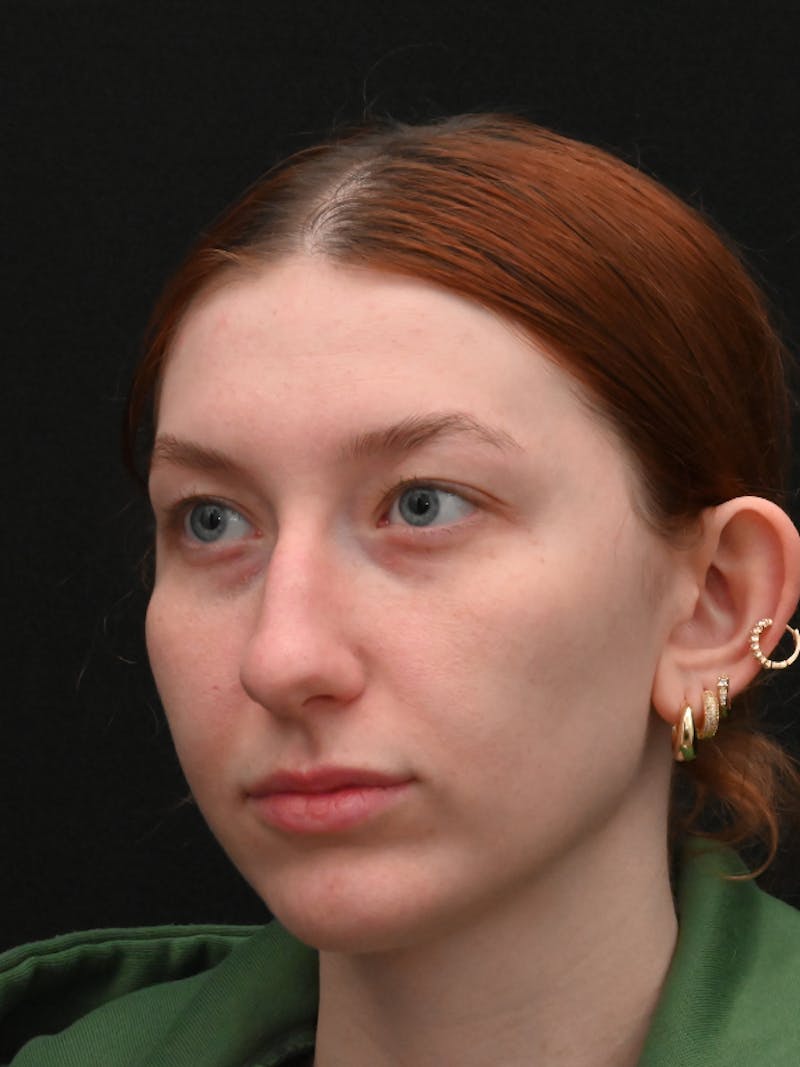 Otoplasty Before & After Gallery - Patient 233584 - Image 7