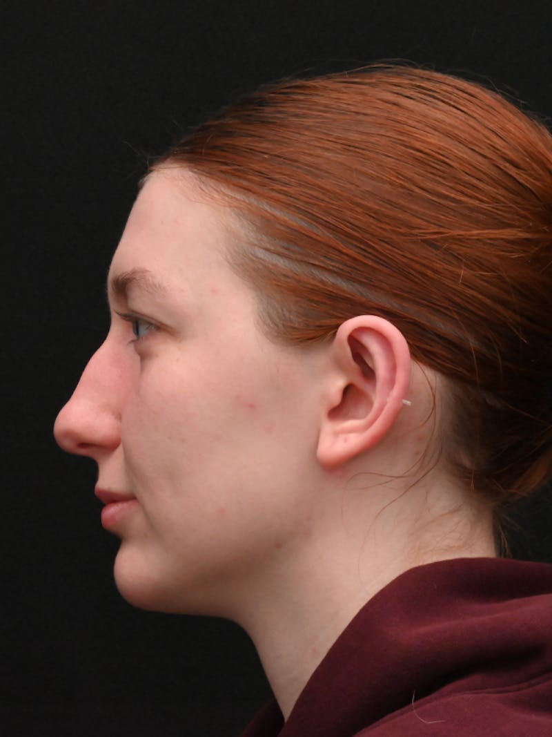 Otoplasty Before & After Gallery - Patient 233584 - Image 10