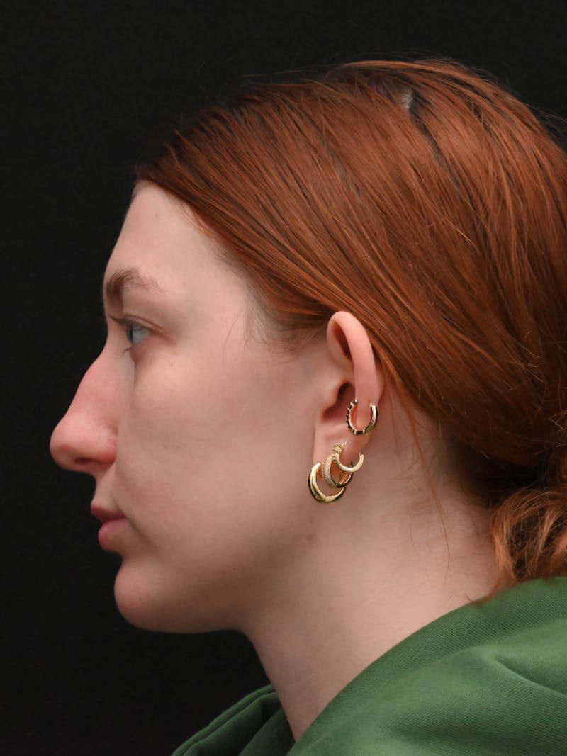 Otoplasty Before & After Gallery - Patient 233584 - Image 9