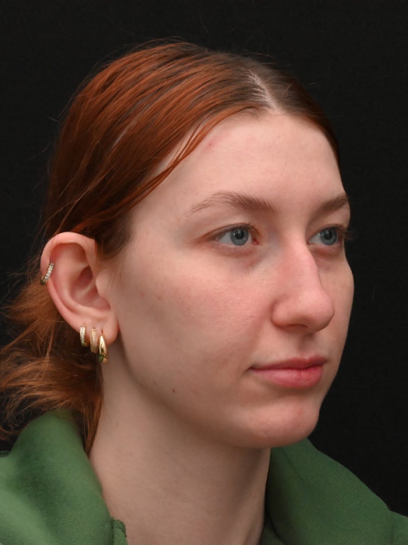 Otoplasty Before & After Gallery - Patient 233584 - Image 5