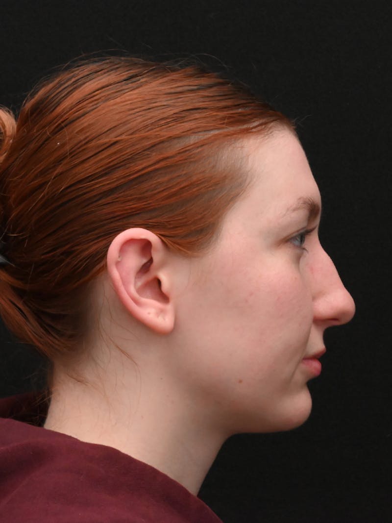 Otoplasty Before & After Gallery - Patient 233584 - Image 4