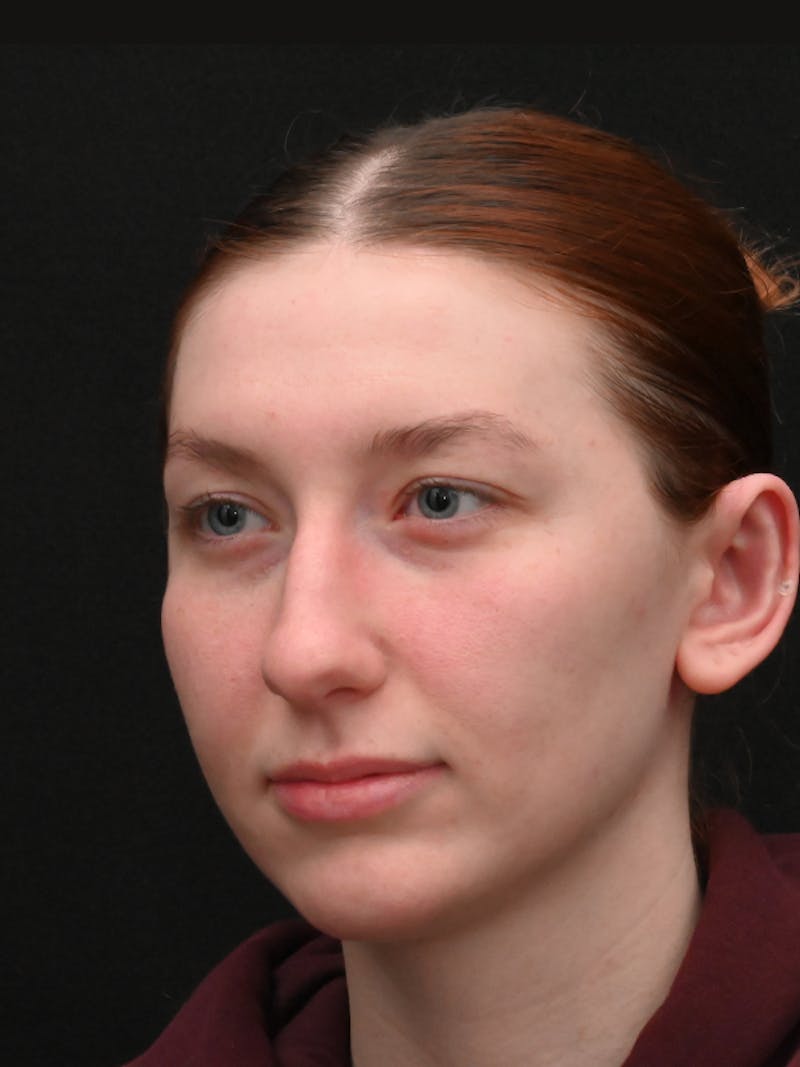 Otoplasty Before & After Gallery - Patient 233584 - Image 8