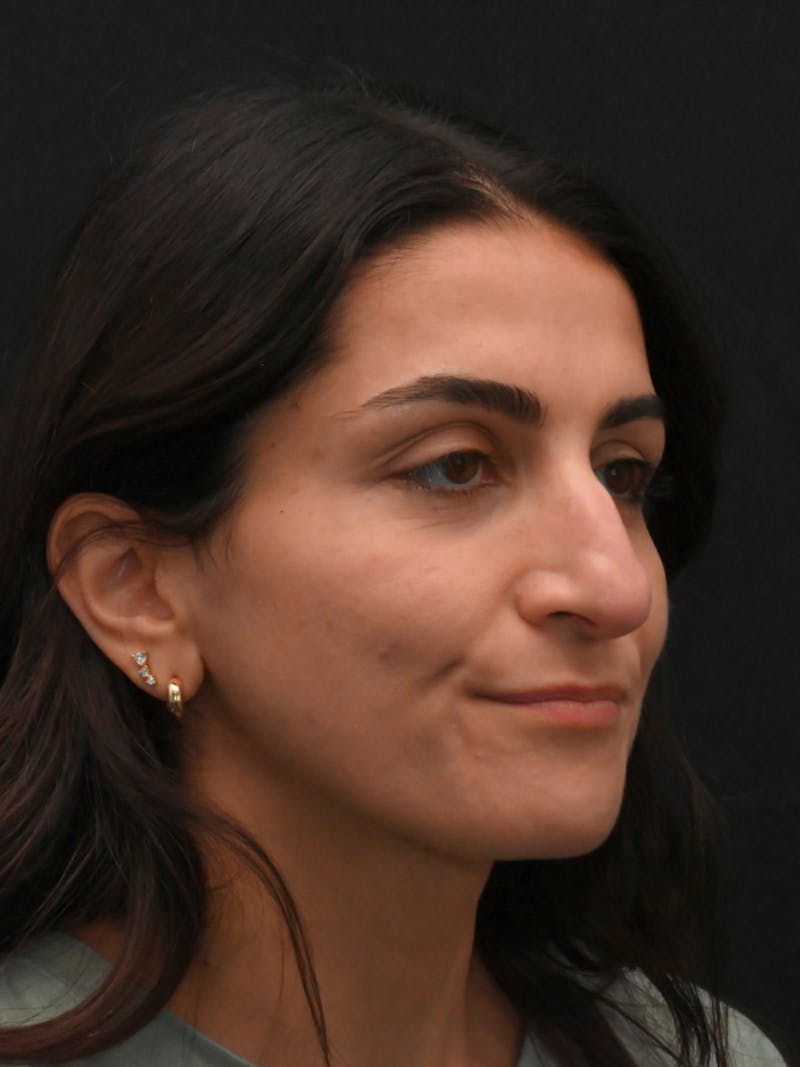 Rhinoplasty Before & After Gallery - Patient 202741 - Image 3