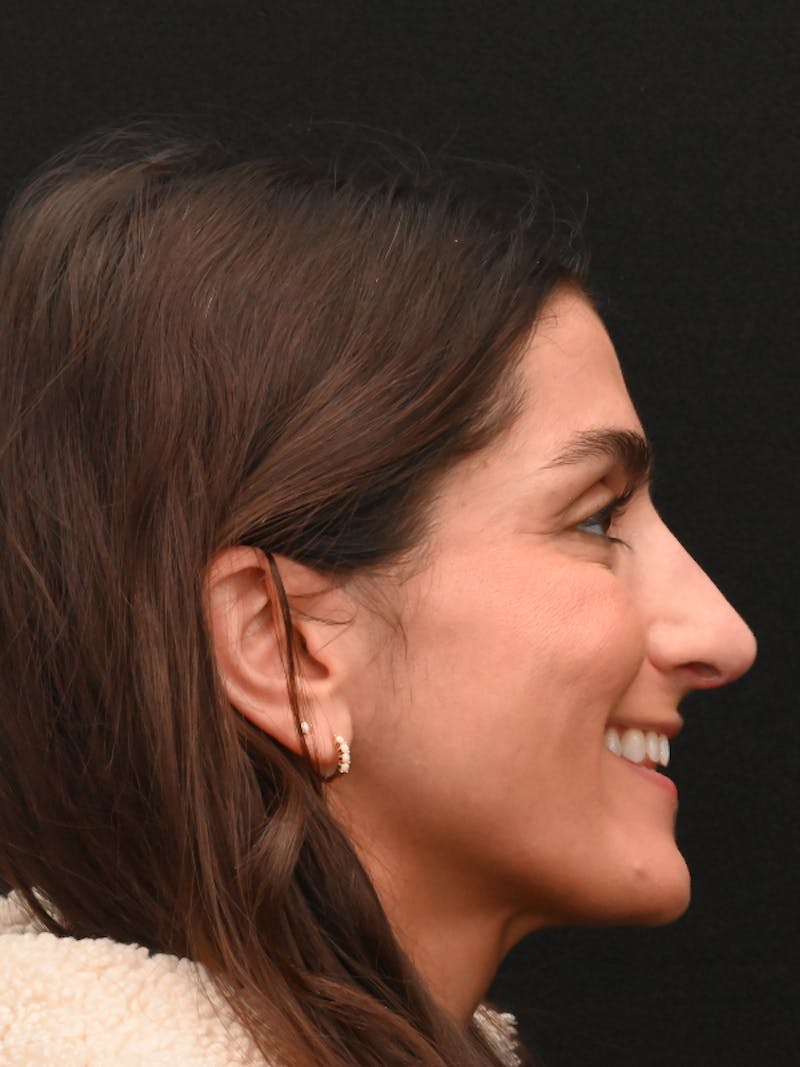 Rhinoplasty Before & After Gallery - Patient 202741 - Image 2