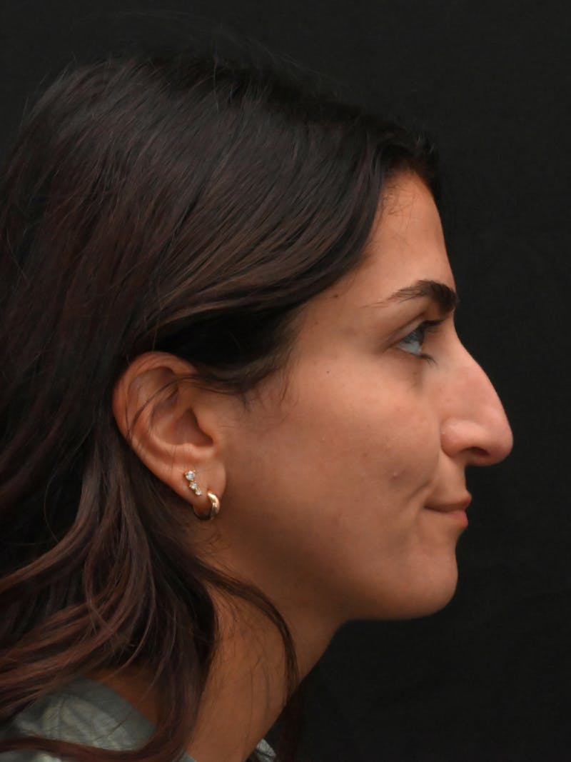 Rhinoplasty Before & After Gallery - Patient 202741 - Image 1