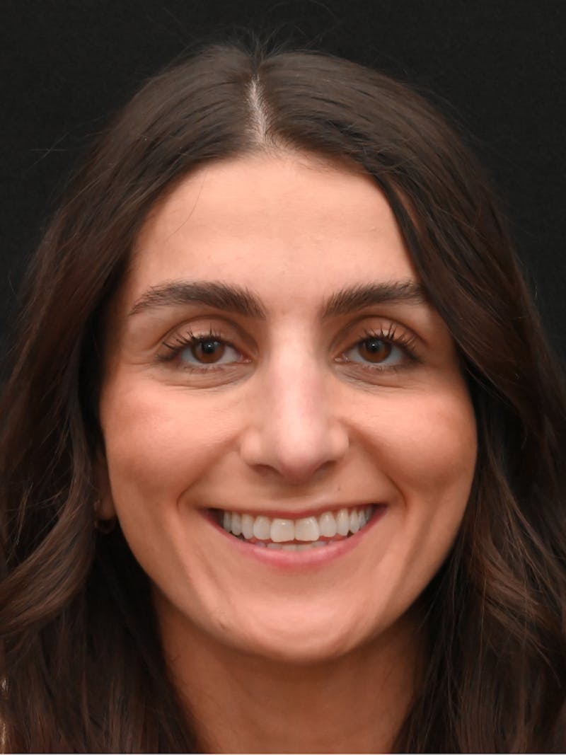 Rhinoplasty Before & After Gallery - Patient 202741 - Image 6