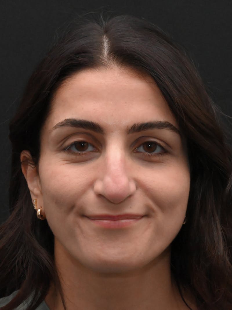 Rhinoplasty Before & After Gallery - Patient 202741 - Image 5