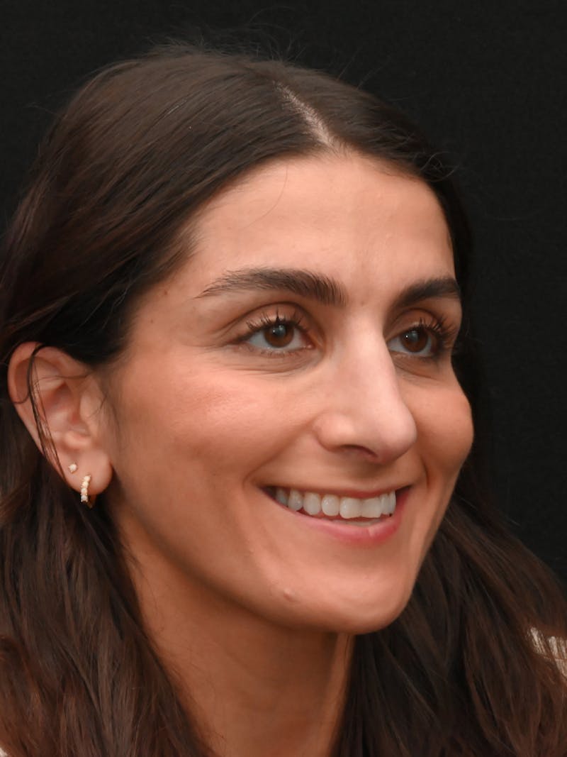 Rhinoplasty Before & After Gallery - Patient 202741 - Image 4