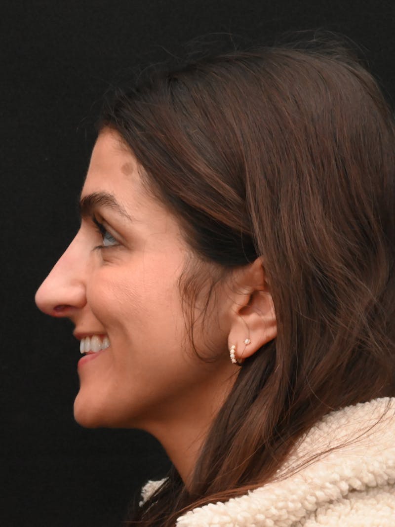 Rhinoplasty Before & After Gallery - Patient 202741 - Image 8