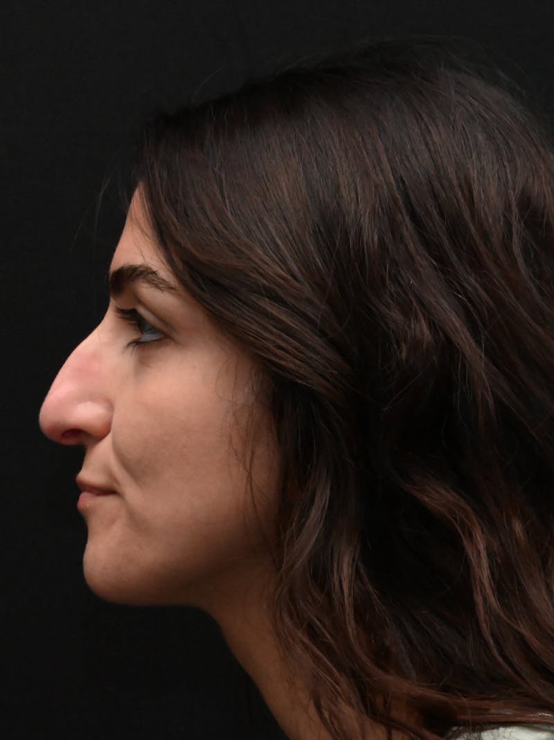 Rhinoplasty Before & After Gallery - Patient 202741 - Image 7