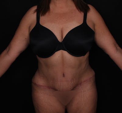 Abdominoplasty Before & After Gallery - Patient 145135 - Image 2