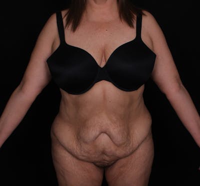 Abdominoplasty Before & After Gallery - Patient 145135 - Image 1