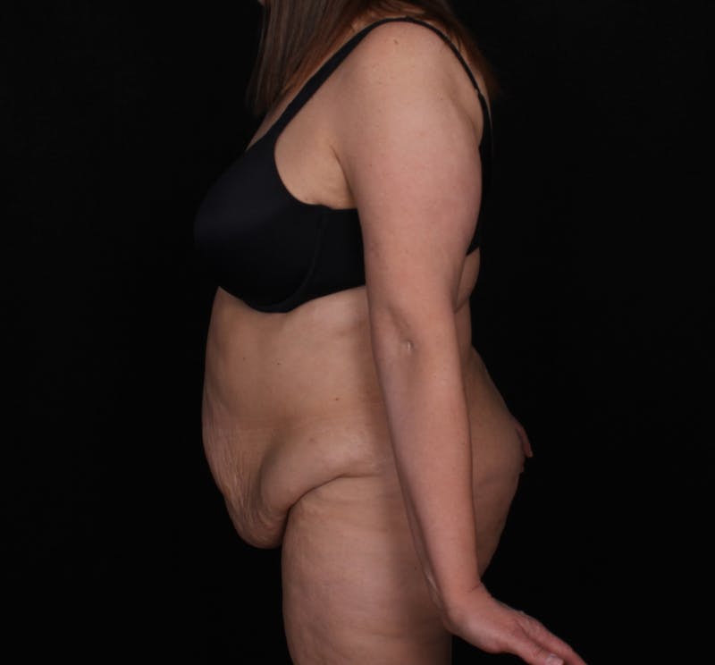Abdominoplasty Before & After Gallery - Patient 145135 - Image 3