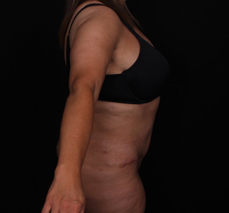 Abdominoplasty Before & After Gallery - Patient 145135 - Image 6