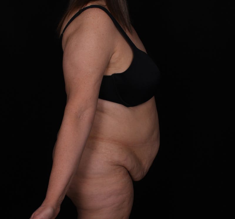 Abdominoplasty Before & After Gallery - Patient 145135 - Image 5