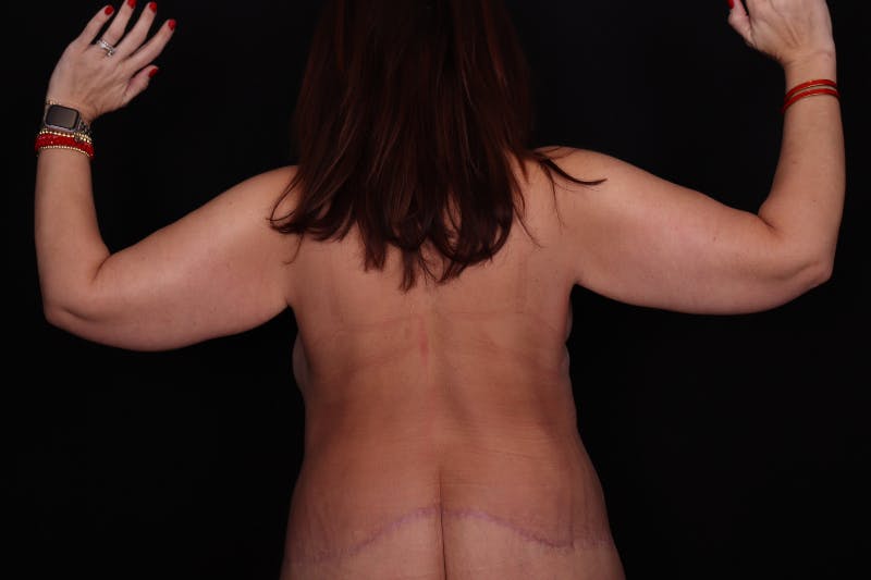 Arm Lift Before & After Gallery - Patient 371253 - Image 4